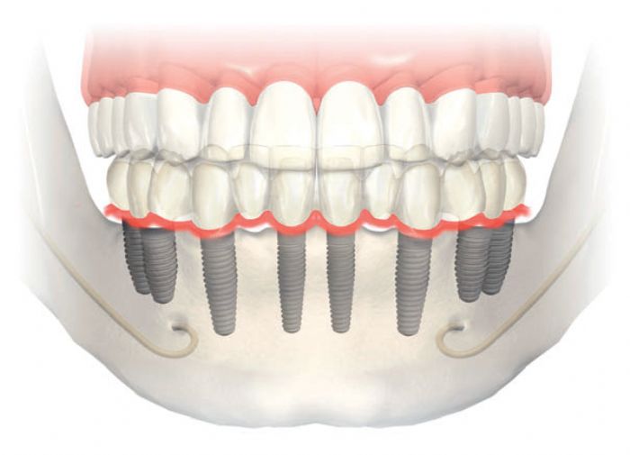 Accesorios para implantes, etc... - Top Implants