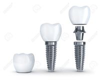 Implante Dental 3.5mm - TOP IMPLANTS